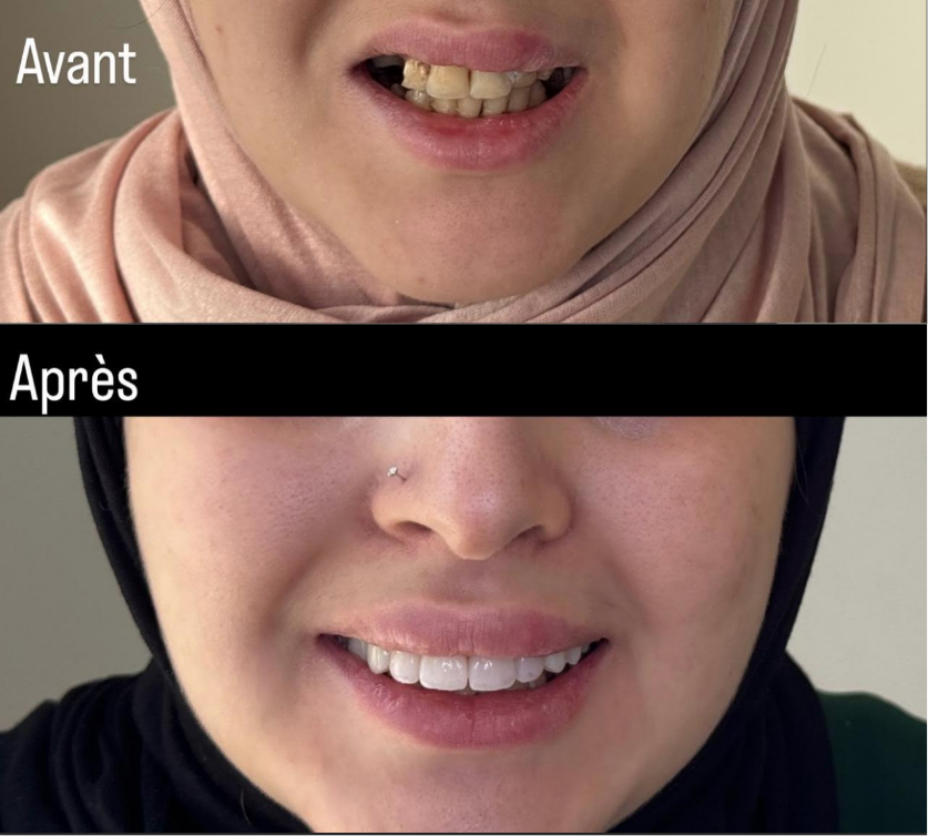 Complete Smile Makeover